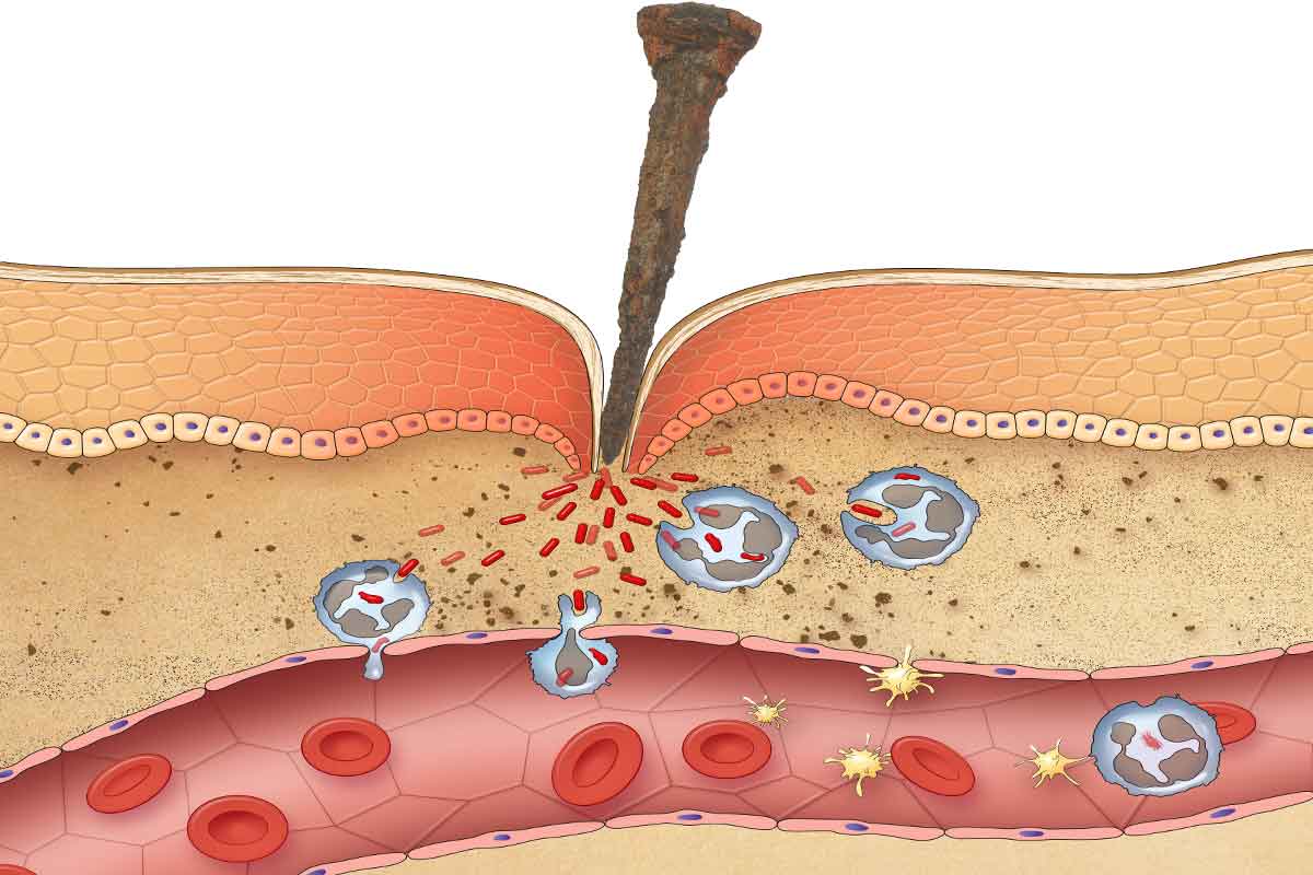 Akute Entzündung, Dermatitis