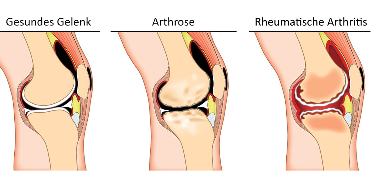 Arthrose,Gelenkerkrankung, Arthritis